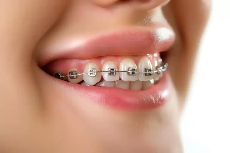 Braces